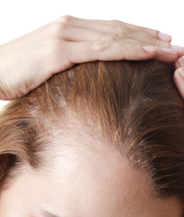 Hair Loss Treatments