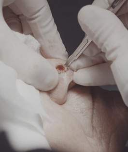 Mohs Surgery 1 Mohs Surgery