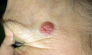 C2 Skin Cancers & Melanomas - 4
