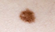 C4 Skin Cancers & Melanomas - 8