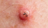 C5 Skin Cancers & Melanomas - 6