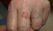 C6 Skin Cancers & Melanomas - 7