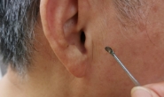Curette Skin Cancers & Melanomas - 12