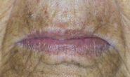 Lips Skin Cancers & Melanomas - 15