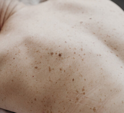 Skin on beds Skin Cancers & Melanomas - 1