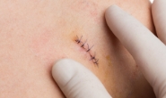 Surgery Skin Cancers & Melanomas - 14