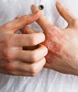 Eczema Treatment