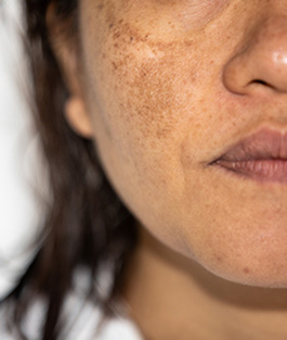 Pigmentation, Brown Spots, White Spots 1 Pigmenation