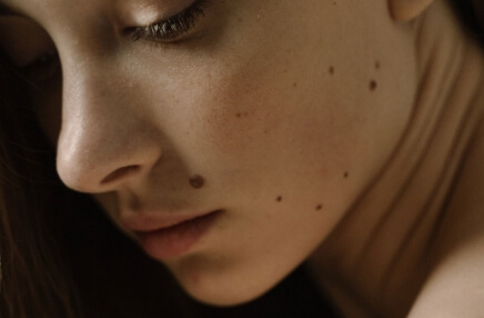 Face moles Services - 3