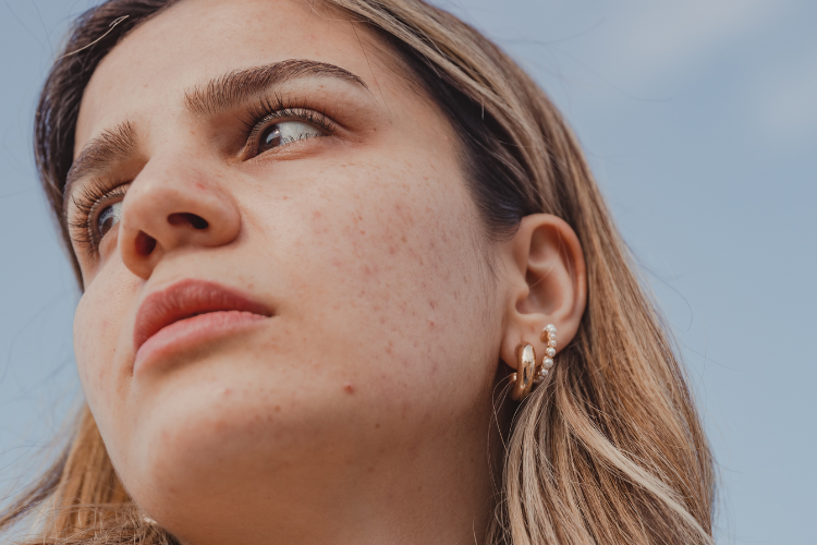 Close-up of an acne-affected face showing the treatment area for AviClear Australia.