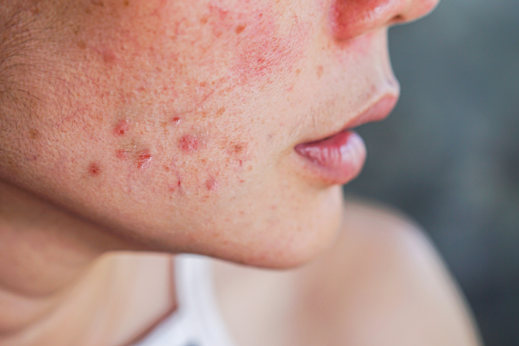 BLOG 2 2 Everything You Need to Know About AviClear Acne Treatment in Australia - 3