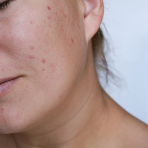 4 Why Are Dermatologists Recommending AviClear Treatment for Acne? - 14