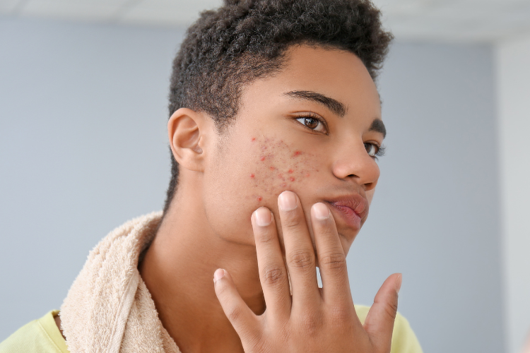 Close-up of an acne-affected face showing the treatment area for AviClear Australia.