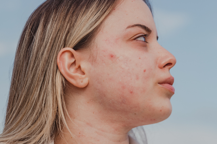 A close-up of a face with visible acne and pimples, showcasing the type of skin conditions AviClear is designed to treat.