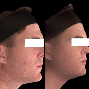 A dramatic before-and-after comparison of a patient's skin after undergoing AviClear laser treatment at The Skin Centre on the Gold Coast, highlighting clear, smooth, and rejuvenated skin.