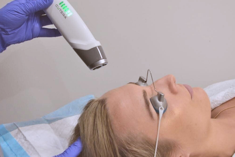 Laser Genesis treatment being performed at The Skin Centre in Gold Coast.