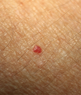 Cherry Angiomas Campbell de Morgan Spots Red Spots Cherry Angiomas (Campbell de Morgan Spots) - 1