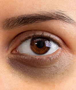Under Eye Dark Circles
