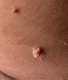 Skin Tags Skin Tags (Acrochordons) - 1