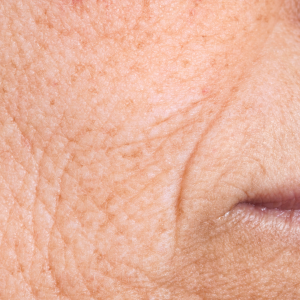Fine lines around a woman’s mouth, an area commonly treated with Laser Genesis.