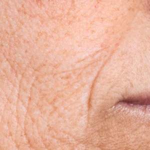 Fine lines around a woman’s mouth, an area commonly treated with Laser Genesis.